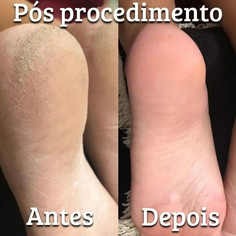 Kit Calo Mahav Calo Feet Spa Para Pés Cps e Cutículas Mais Macias Pro